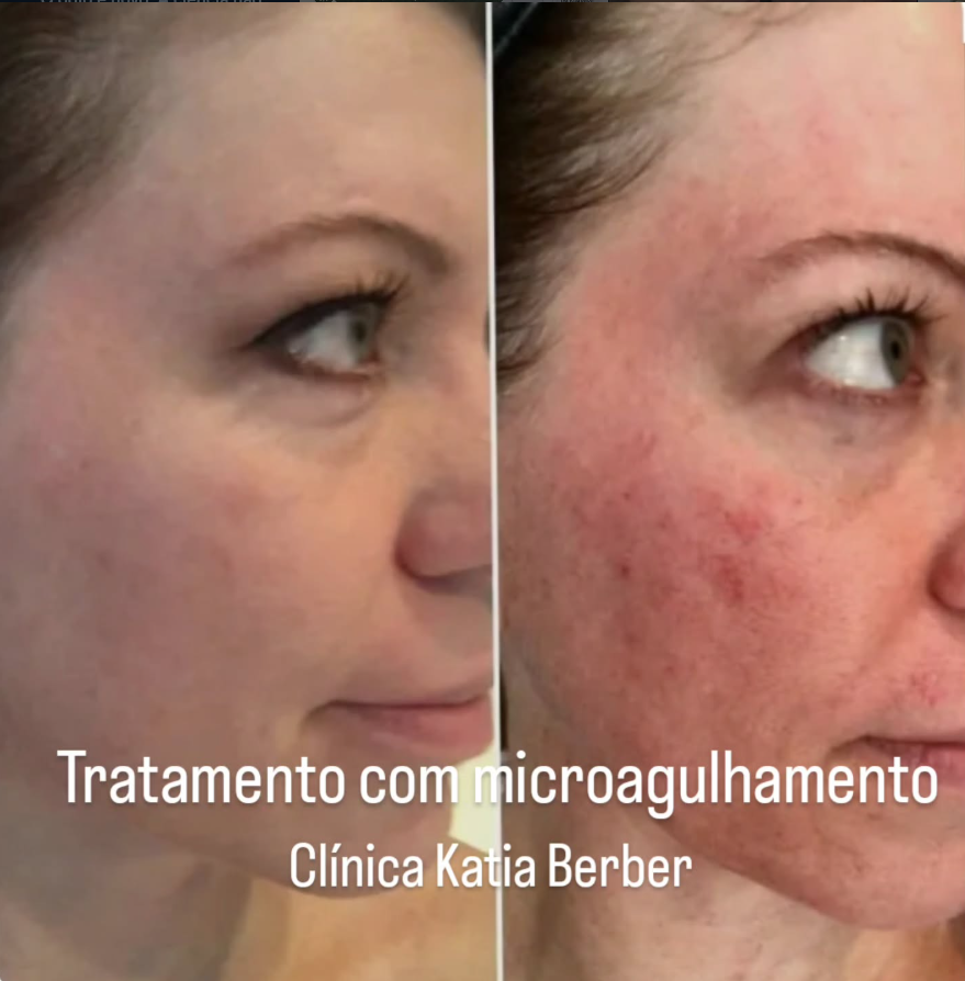 Antes e Depois - Microagulhamento Clínica Katia Berber