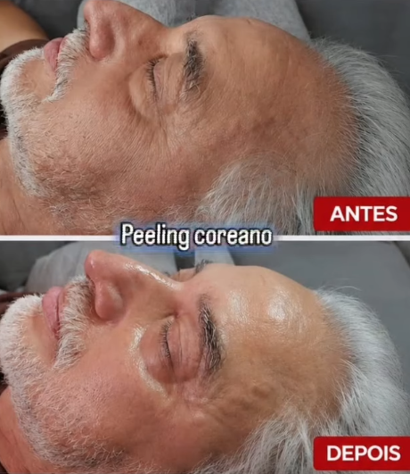 Antes e Depois - Peeling Coreano Clínica Katia Berber