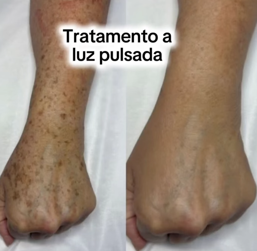 Antes e Depois - Luz Pulsada Clínica Katia Berber